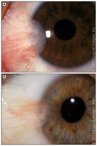 تصویر ناخنک چشم