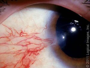 ناخنک با احزا عروقی