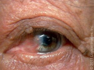 ناخنک با احزا عروقی 